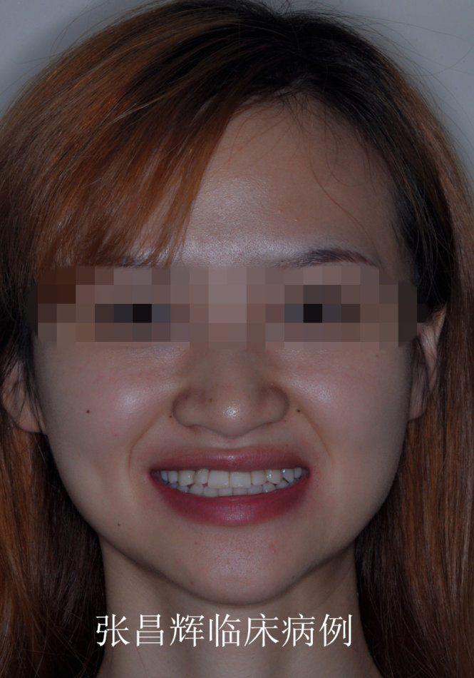 成人骨性反颌掩饰性正畸治疗