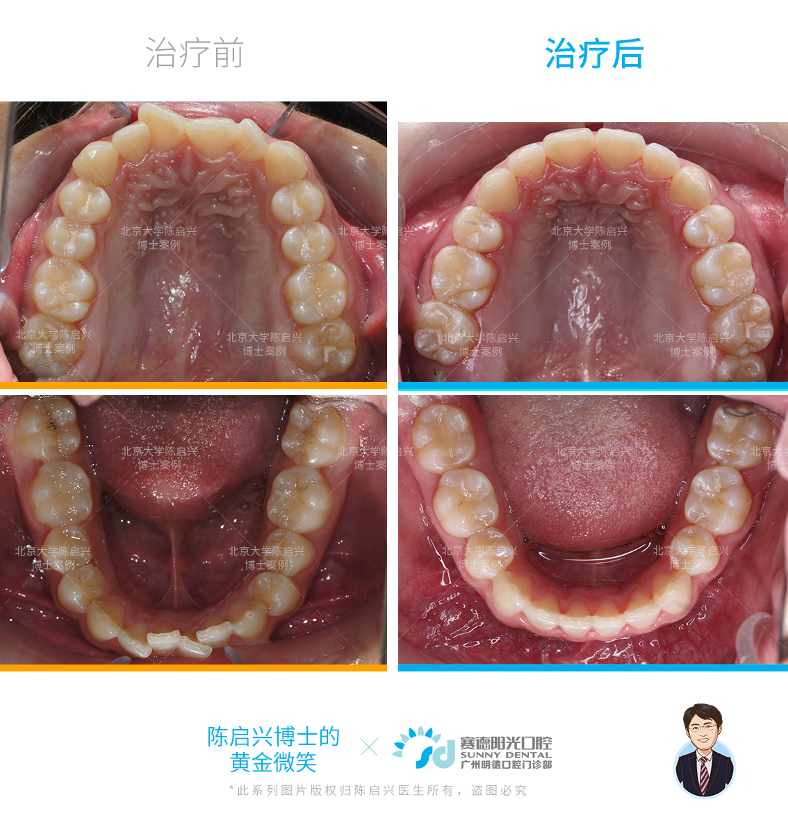 牙齿矫正牙列拥挤图片图片