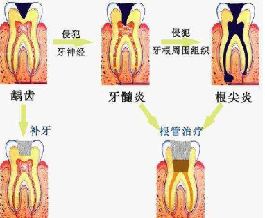 牙髓炎图片原因图片