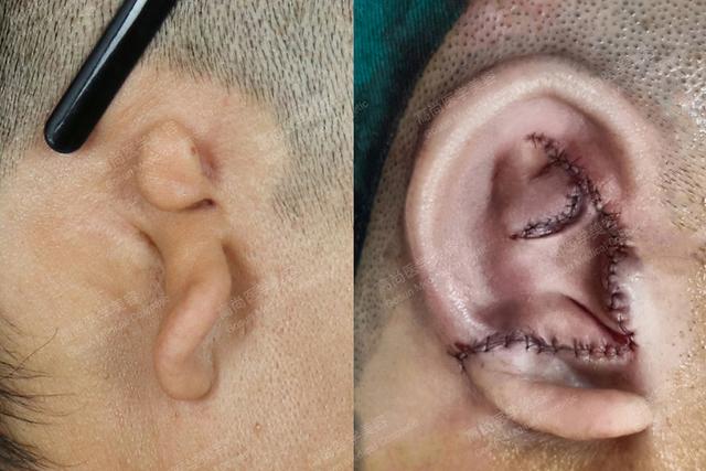 耳部整形手术这样做出来的耳朵才更真实