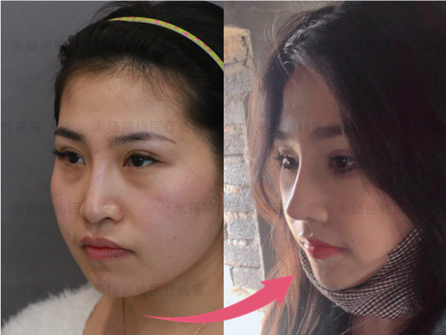 隆鼻硅胶假体下滑怎么办