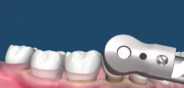 牙齿抛光是什么对牙齿有伤害吗