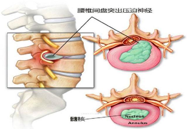 教你判断自己是哪段腰椎间盘突出了