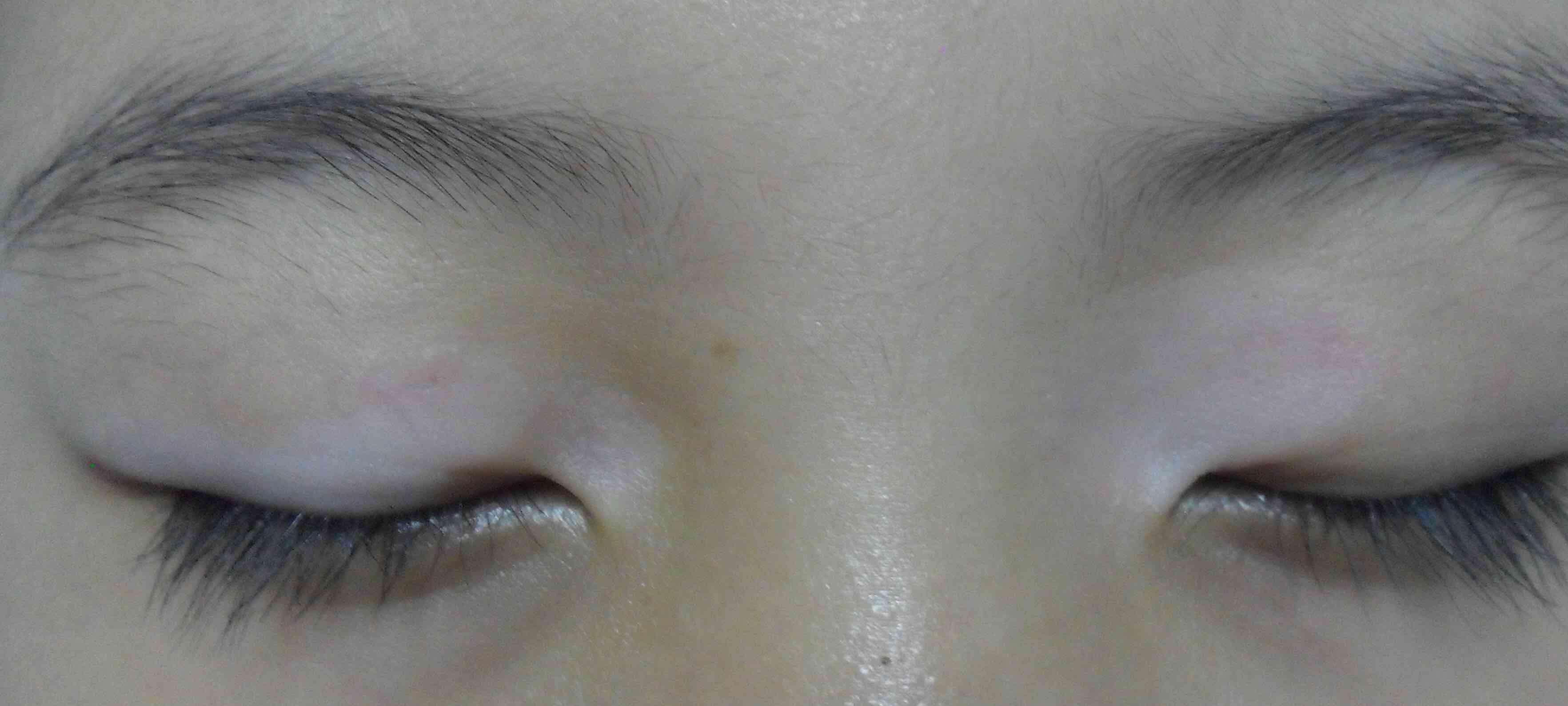 眼睑部白癜风2月余眼睑白斑wood灯检查: 皮损颜色呈白色治疗3个月
