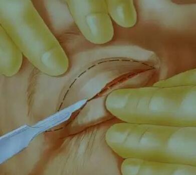 图解,切开双眼皮手术全过程