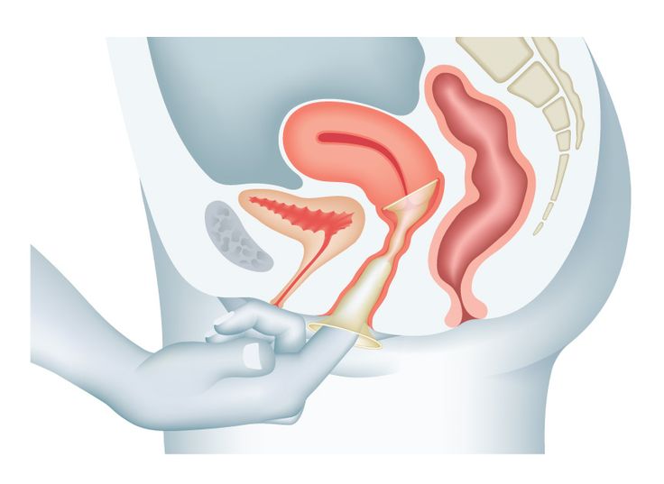 情人节安全手册:切┛拥谋茉蟹椒.-陈舒-爱问医生