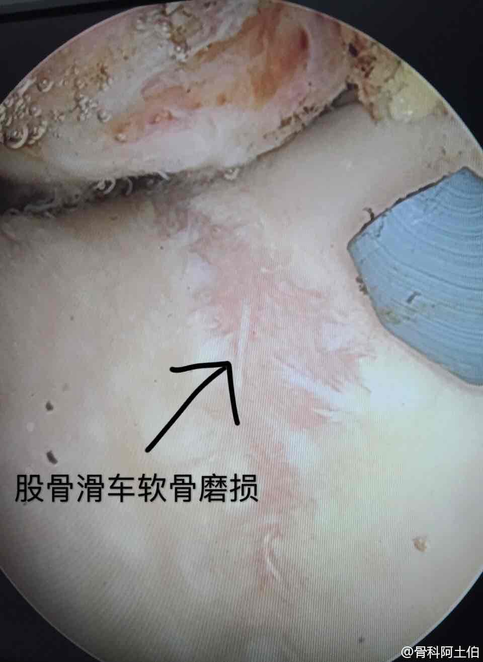 巨大游离体