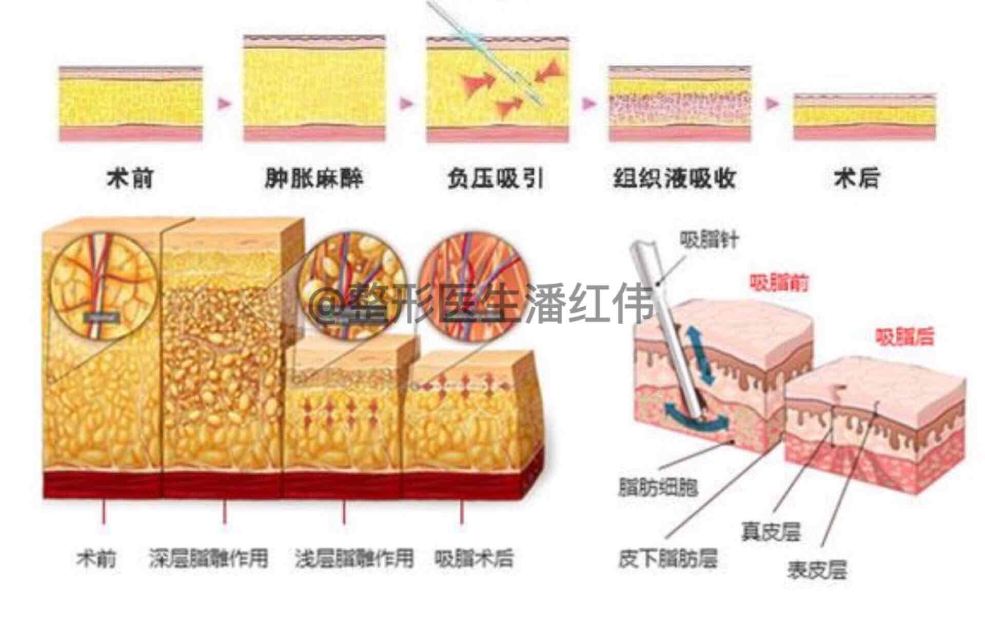 技术从早期的"干抽法",到目前普遍采用的"湿抽法",从早期的超声波吸脂