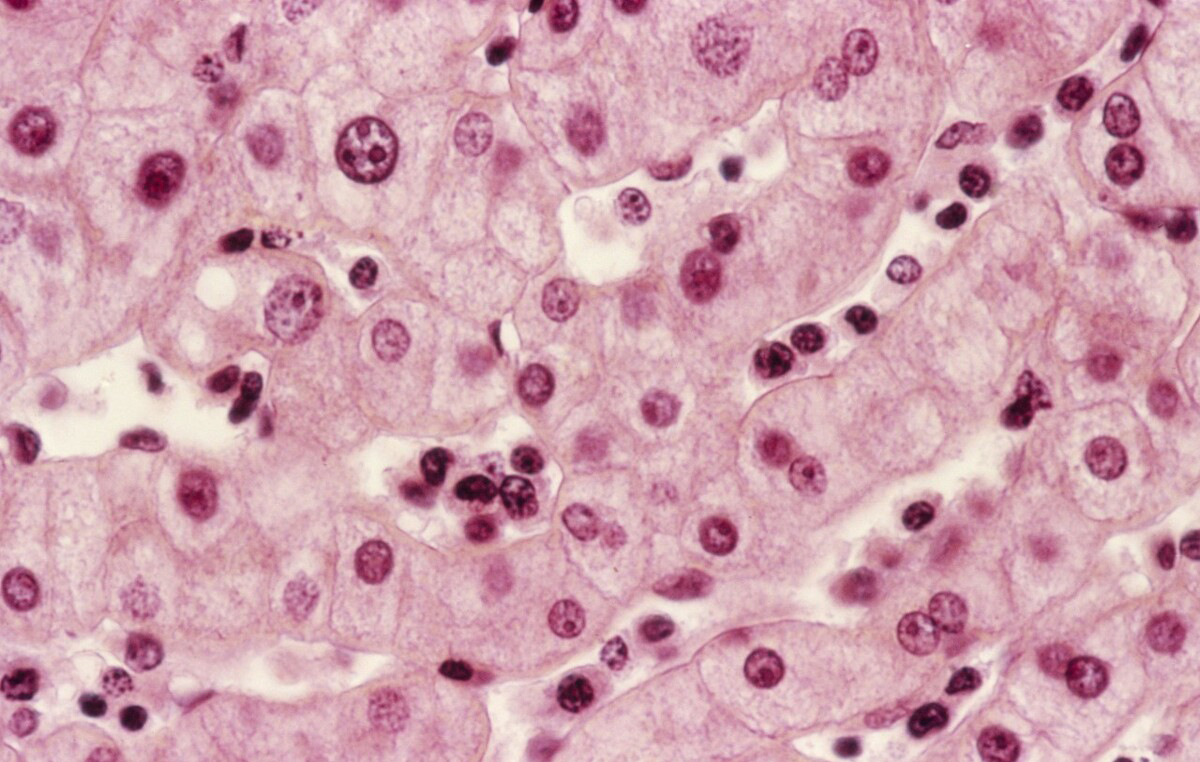 小细胞肺癌平均生存时间一年,如何预防,主要的几点病因要避免