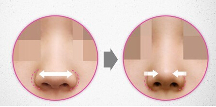 鼻翼缩小手术是做内切好还是外切好?会不会增生?