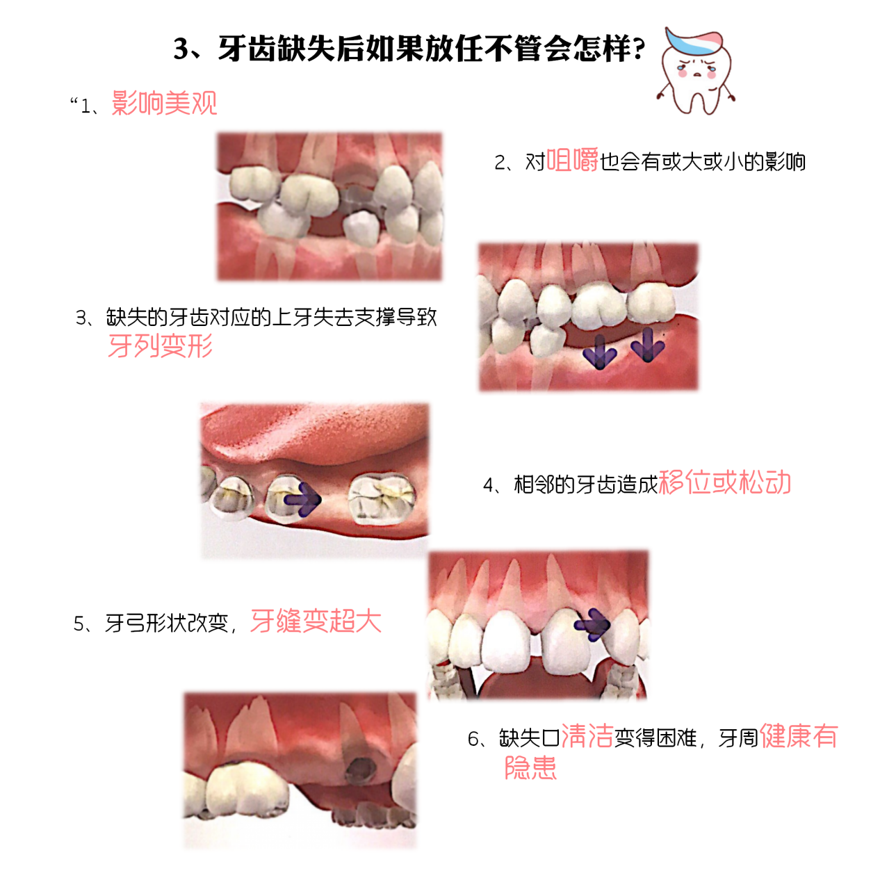 压低磨牙用腭侧种植支抗植入术