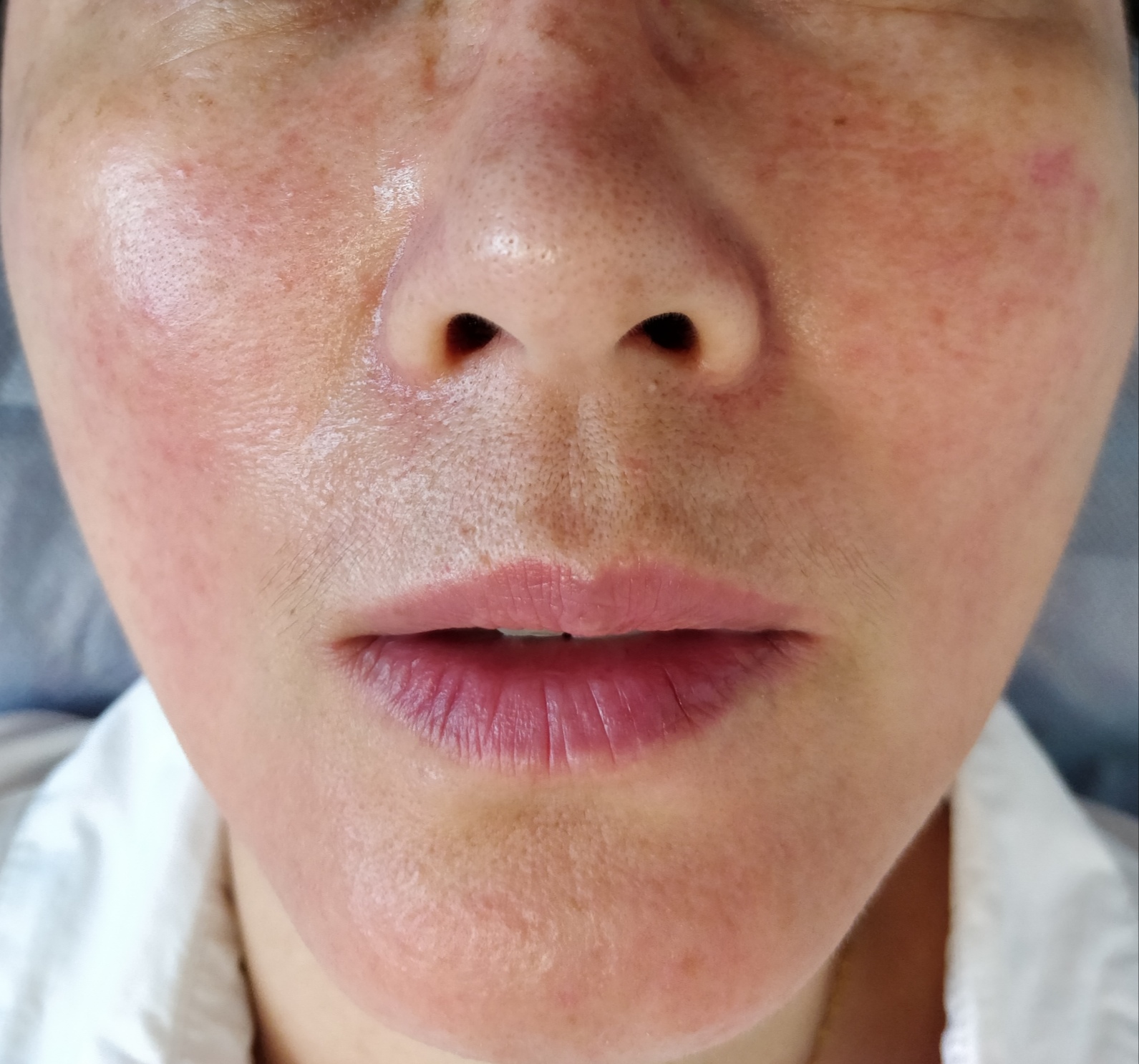 玫瑰痤疮潮红灼热怎么整