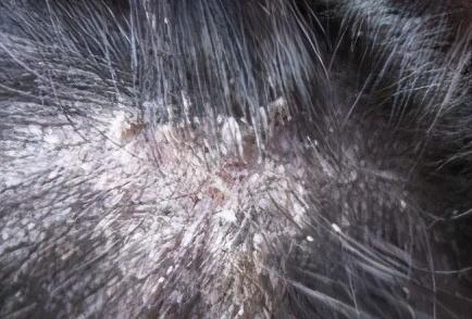 头部脂溢性皮炎应该久洗头日常脂溢性皮炎如何改善以及预防