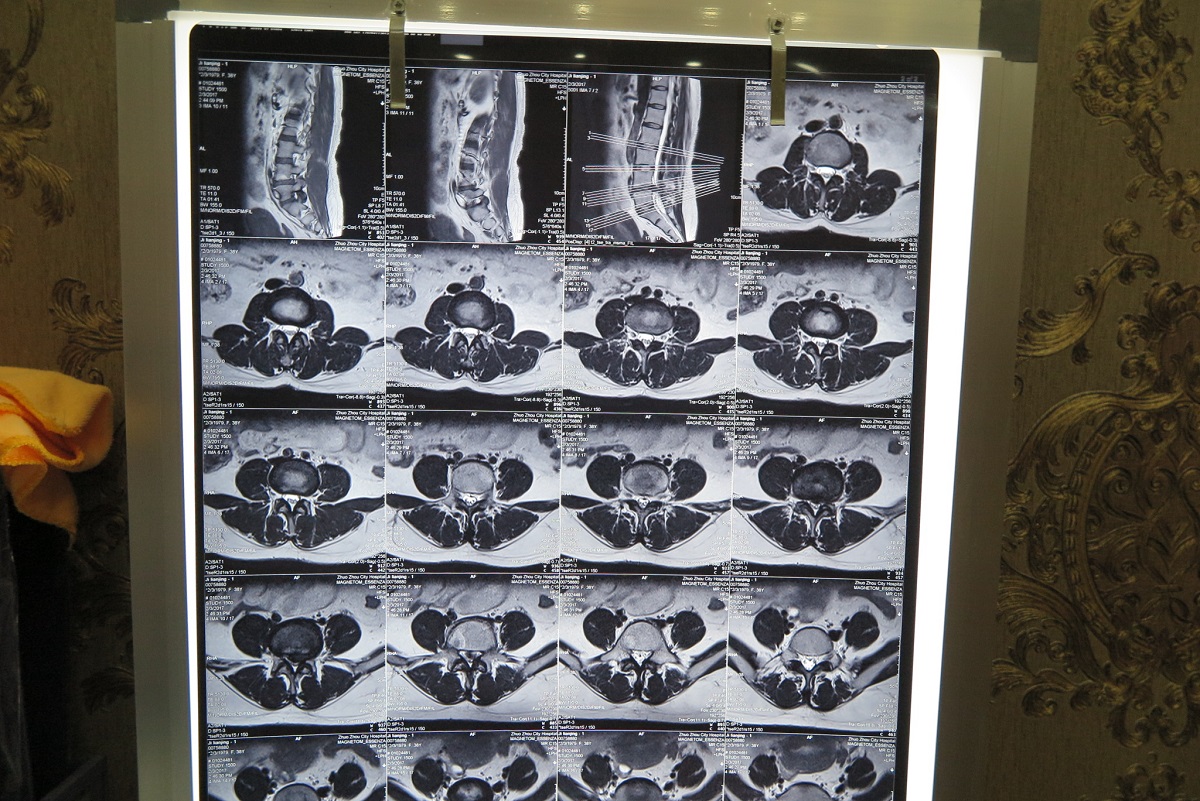 夫妻倆帶來了一些檢查片子,mri:l4/5椎間盤脫出,椎管狹窄,椎體終板炎.