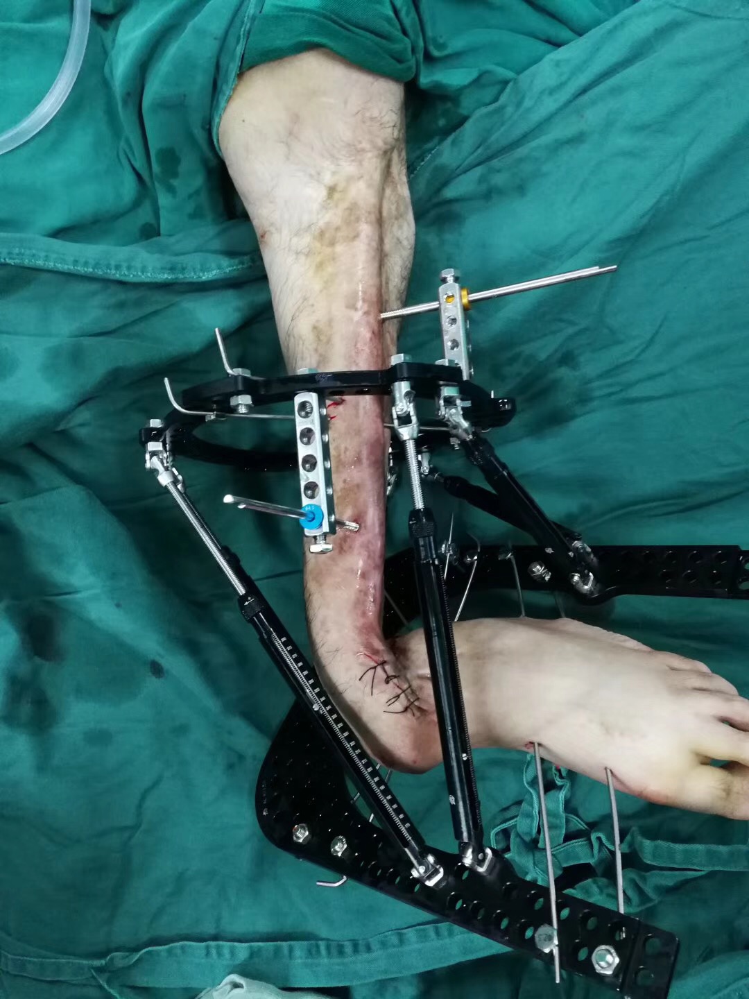 很有难度的腿部畸形矫正