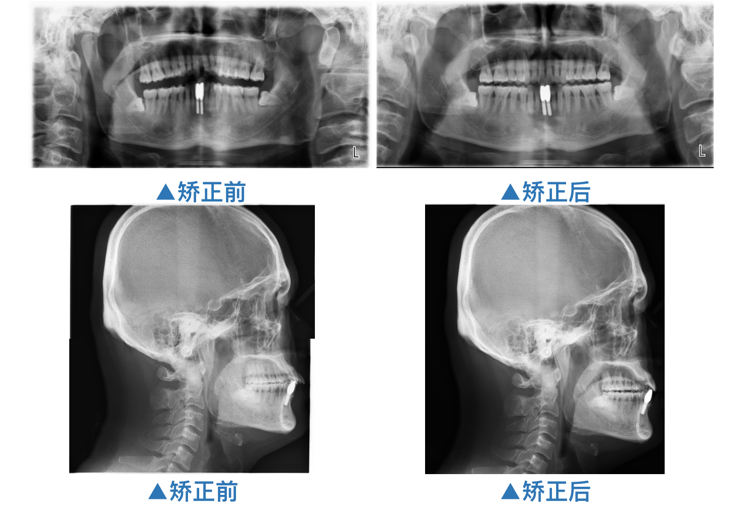 牙缝大,不敢笑,不用担心,矫正来帮忙