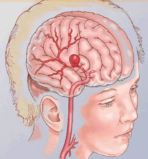 颅内动脉瘤不是肿瘤却像炸弹一样危险