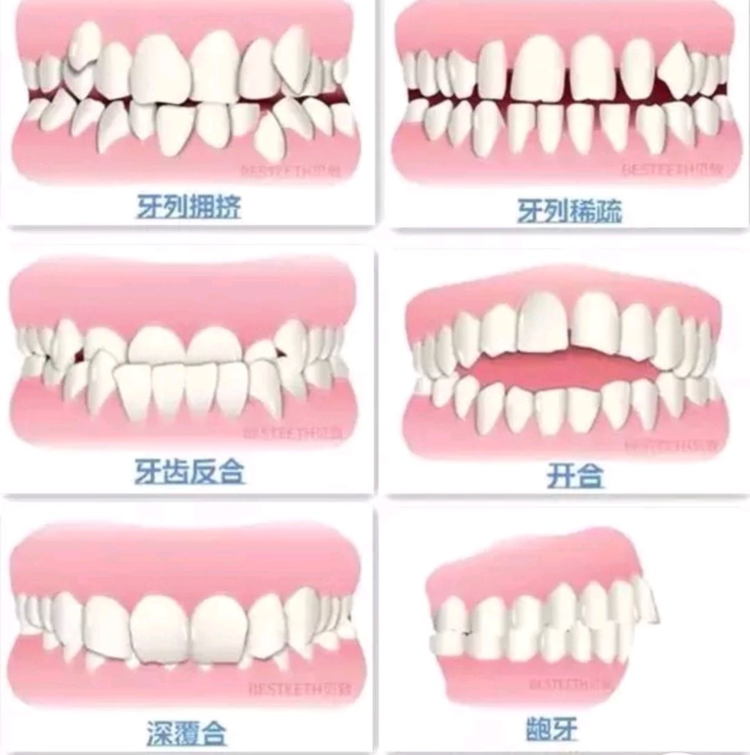 门牙矫正图片,门牙矫正,两颗大门牙突出图片_大山谷图库