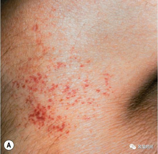 哪些皮肤病变易误诊为过敏性紫癜(iga血管炎)?