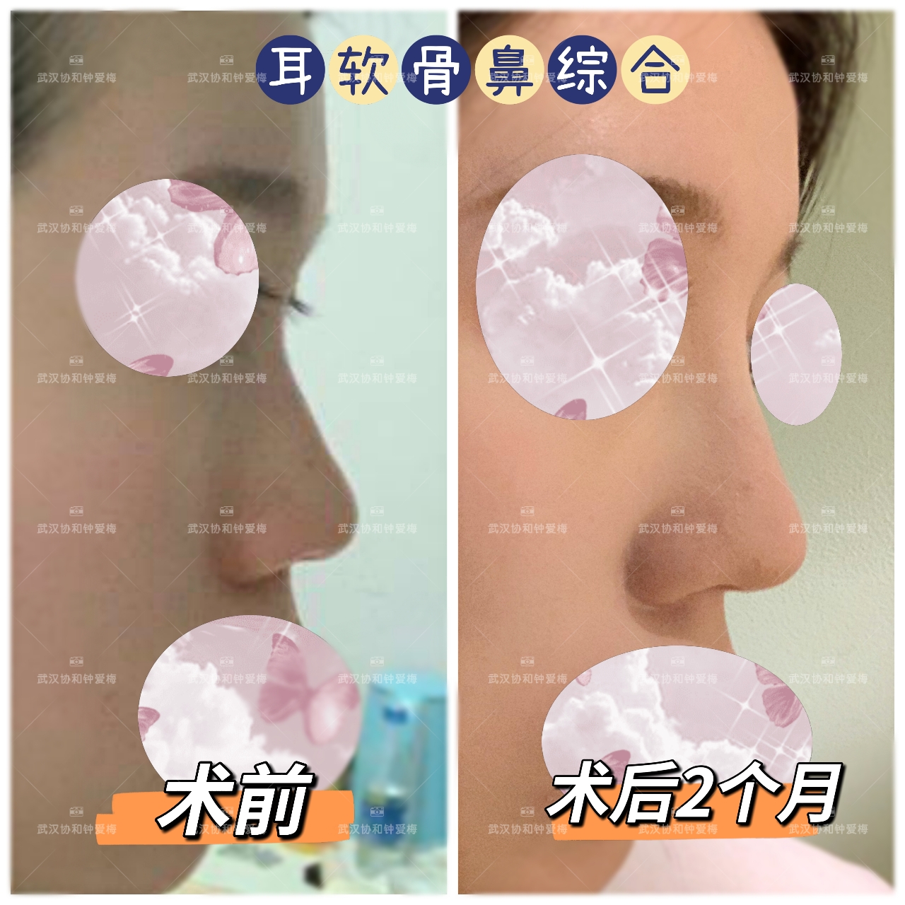 耳软骨鼻综合案例分享 钟爱梅副主任医师 爱问医生