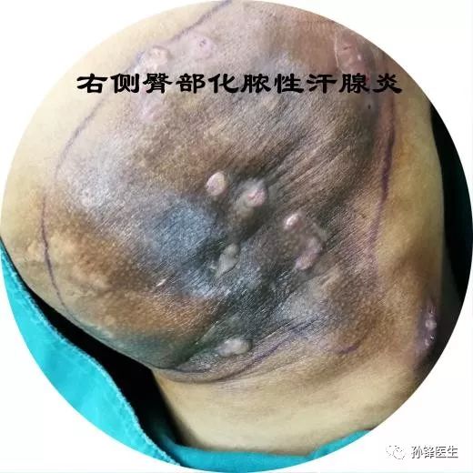 化脓性汗腺炎 治不好图片