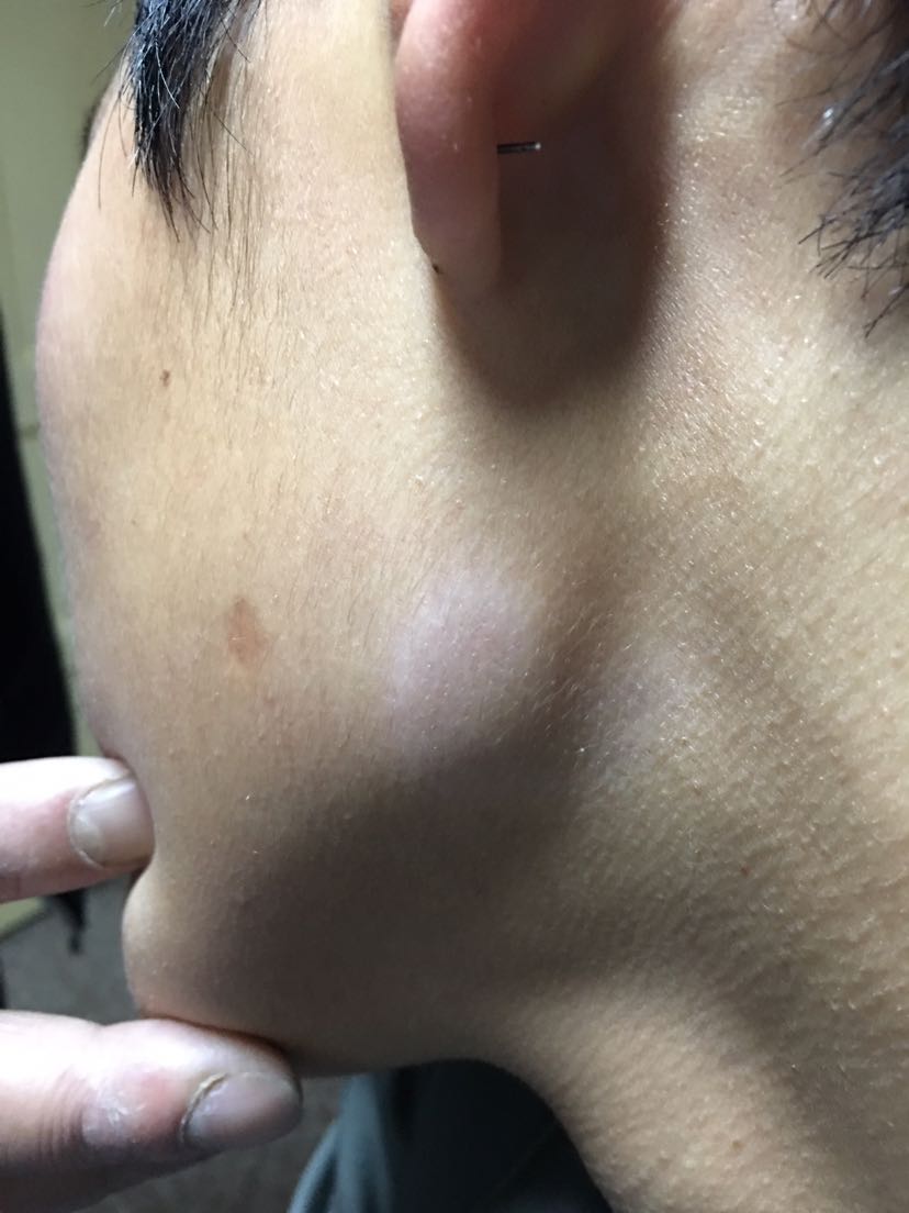 双侧眉弓内角和左侧下颌角拇指大小界限不是很清楚色素减退斑伴有皮屑