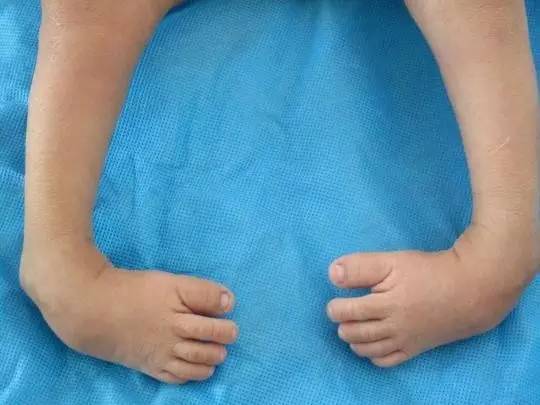 孩子患上马蹄足有人花十余万都没见好