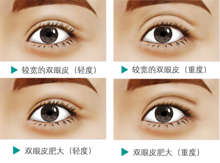 一眼就被看出是割的双眼皮,其次形成双眼皮的皮肤褶皱不是在睑板上