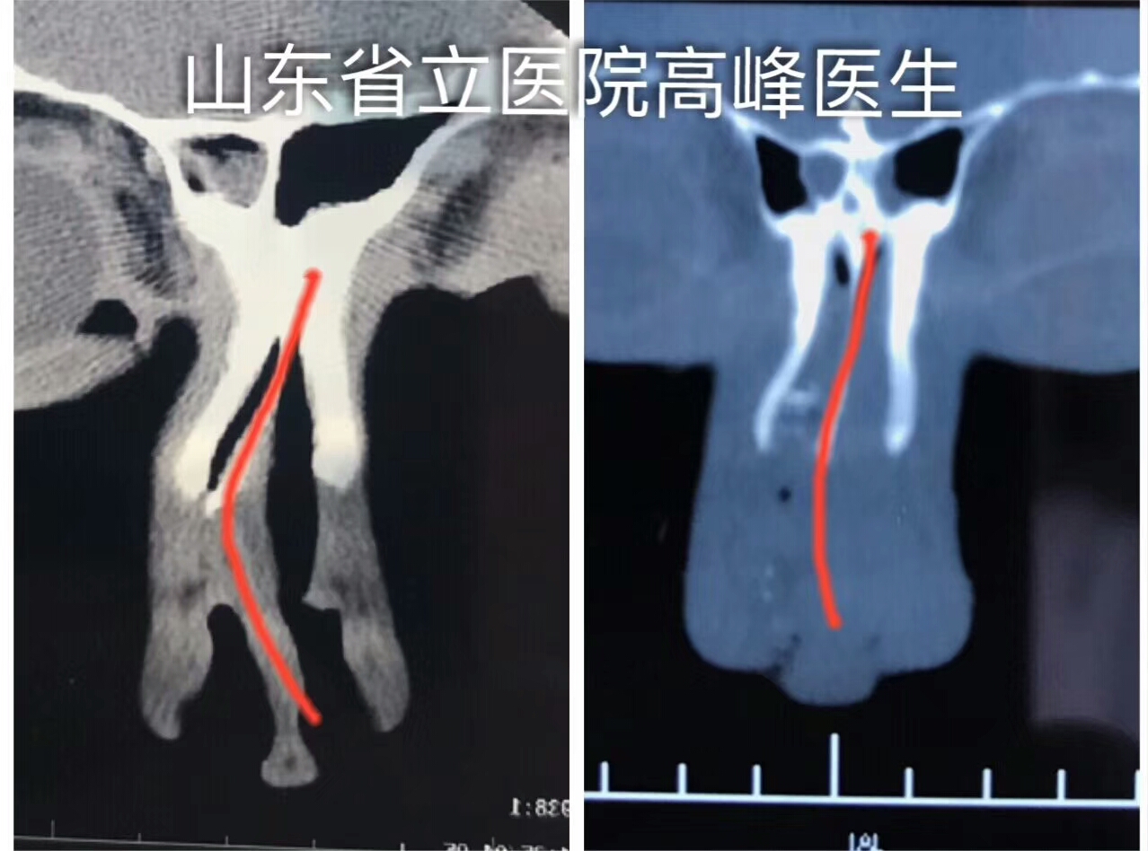 醫生心得術後效果預期:修正鼻中隔使五官更美觀手術項目名稱:歪鼻糾正