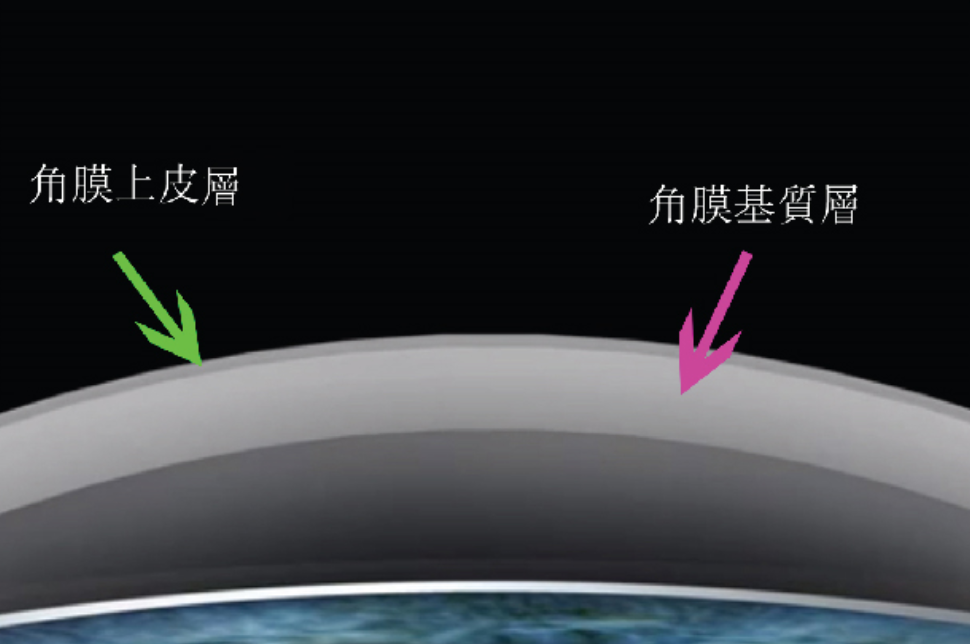 中间(即第三层)的角膜基质层占整个角膜厚度约九成,是角膜五层结构中