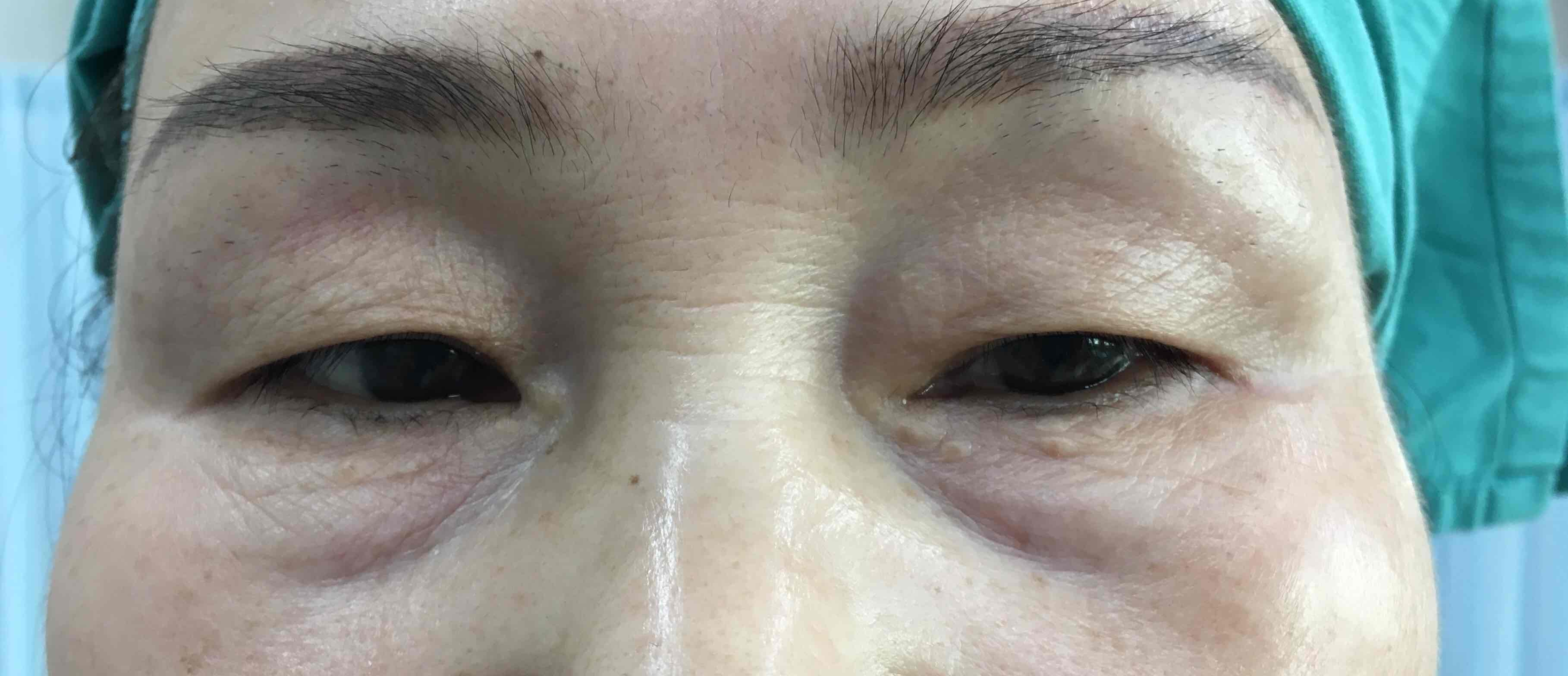 老年性上睑皮肤松弛的治疗策略-臧梦青副主任医师-爱问医生