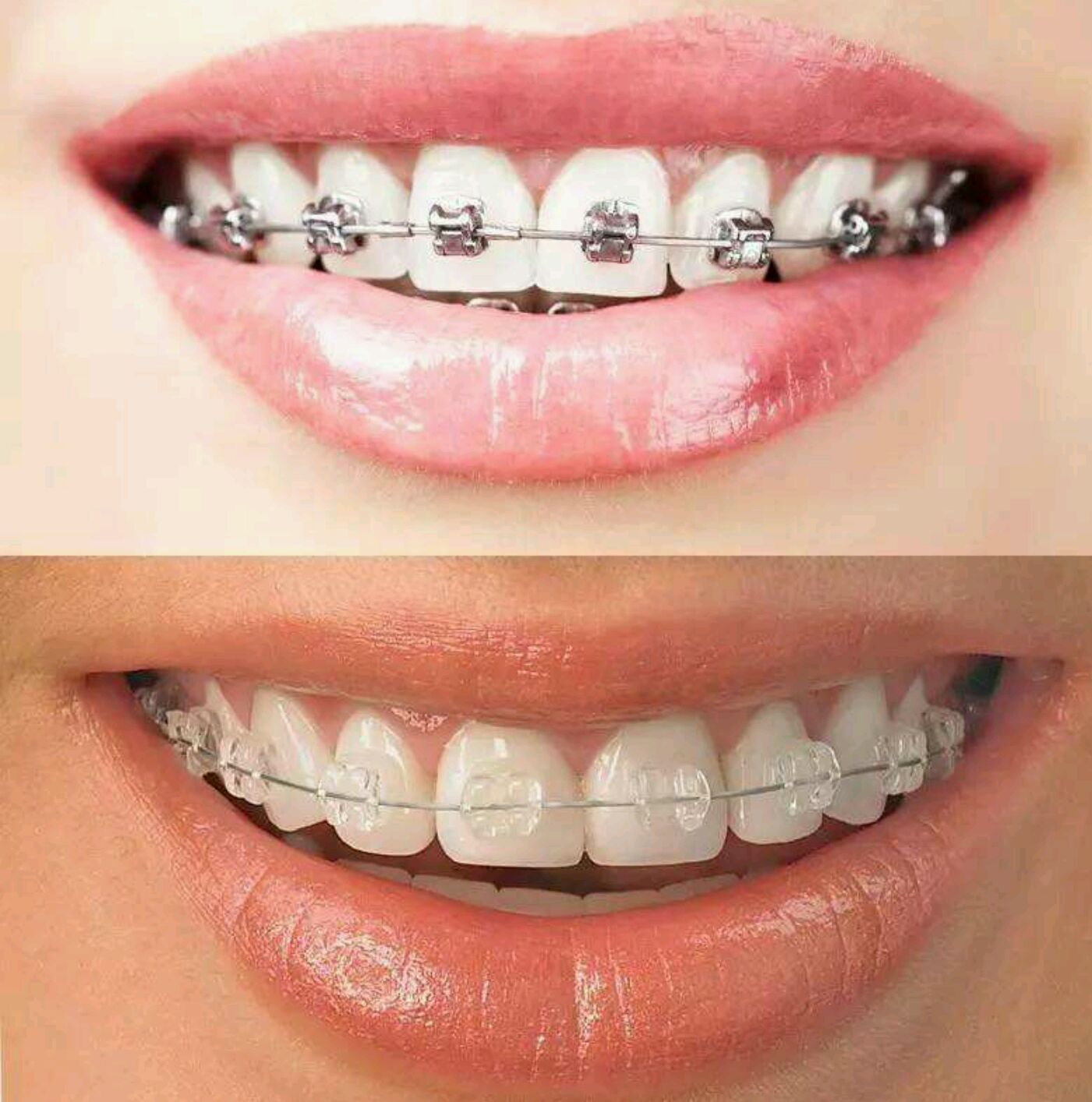 整齐的牙齿让你的颜值加分