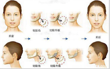 下颌角整形手术切口分类