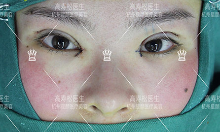 内眦赘皮 手术图片