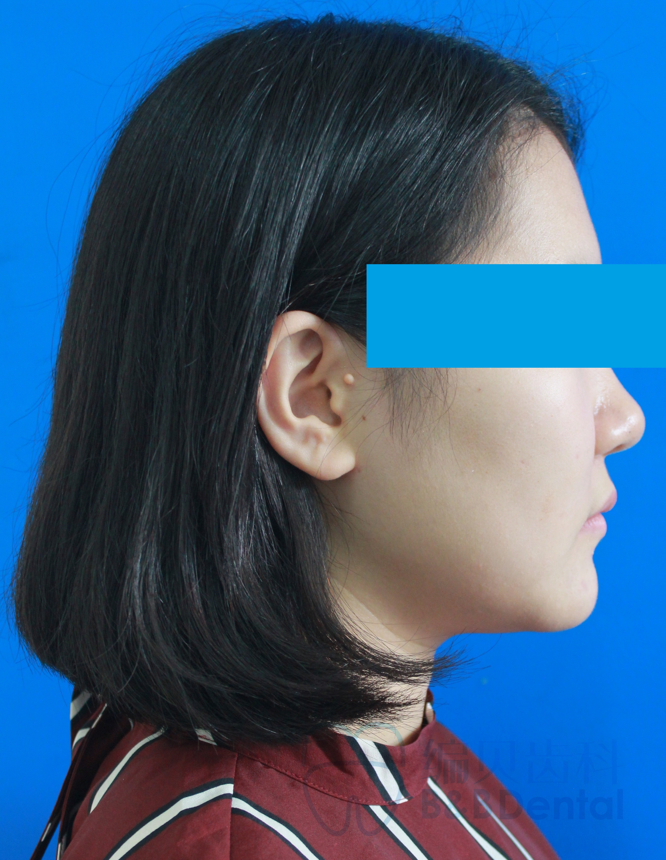 内倾型深覆合蜕变记