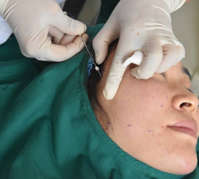 医美科普面部线雕最透彻的讲解