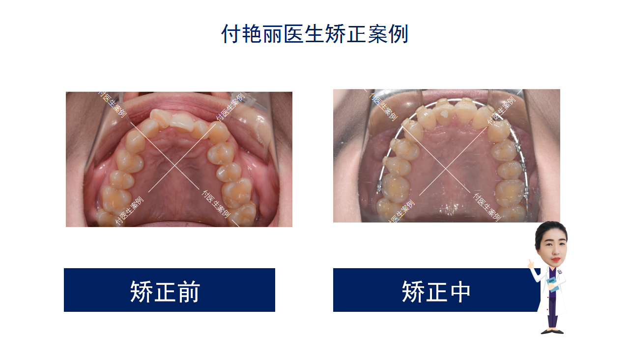 你期待这样的矫正惊喜吗?