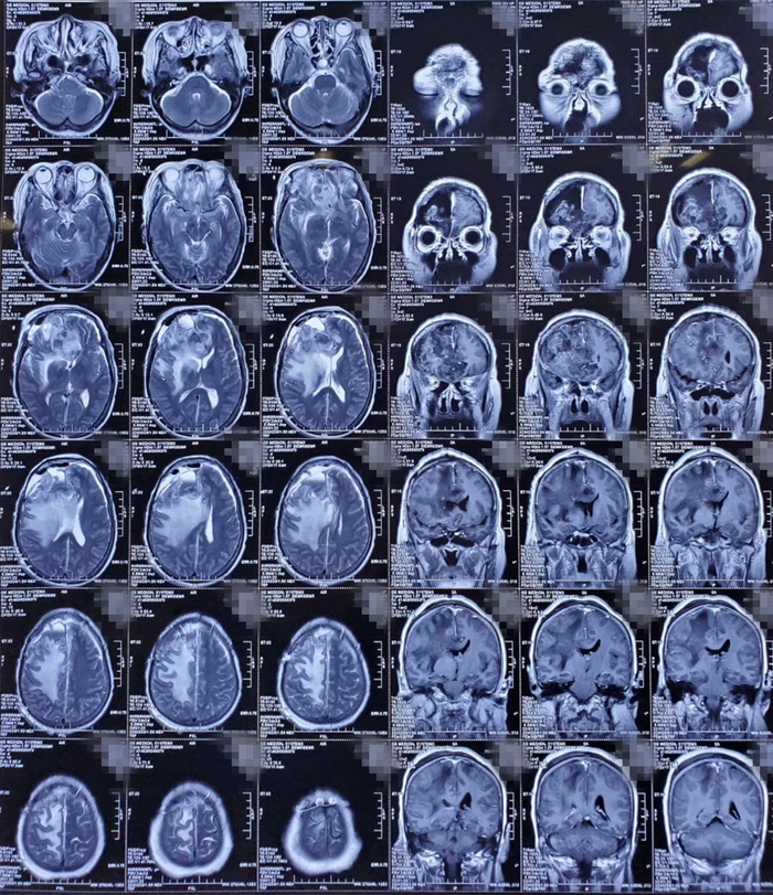 病例分享头疼头晕呕吐竟查出巨大脑膜瘤