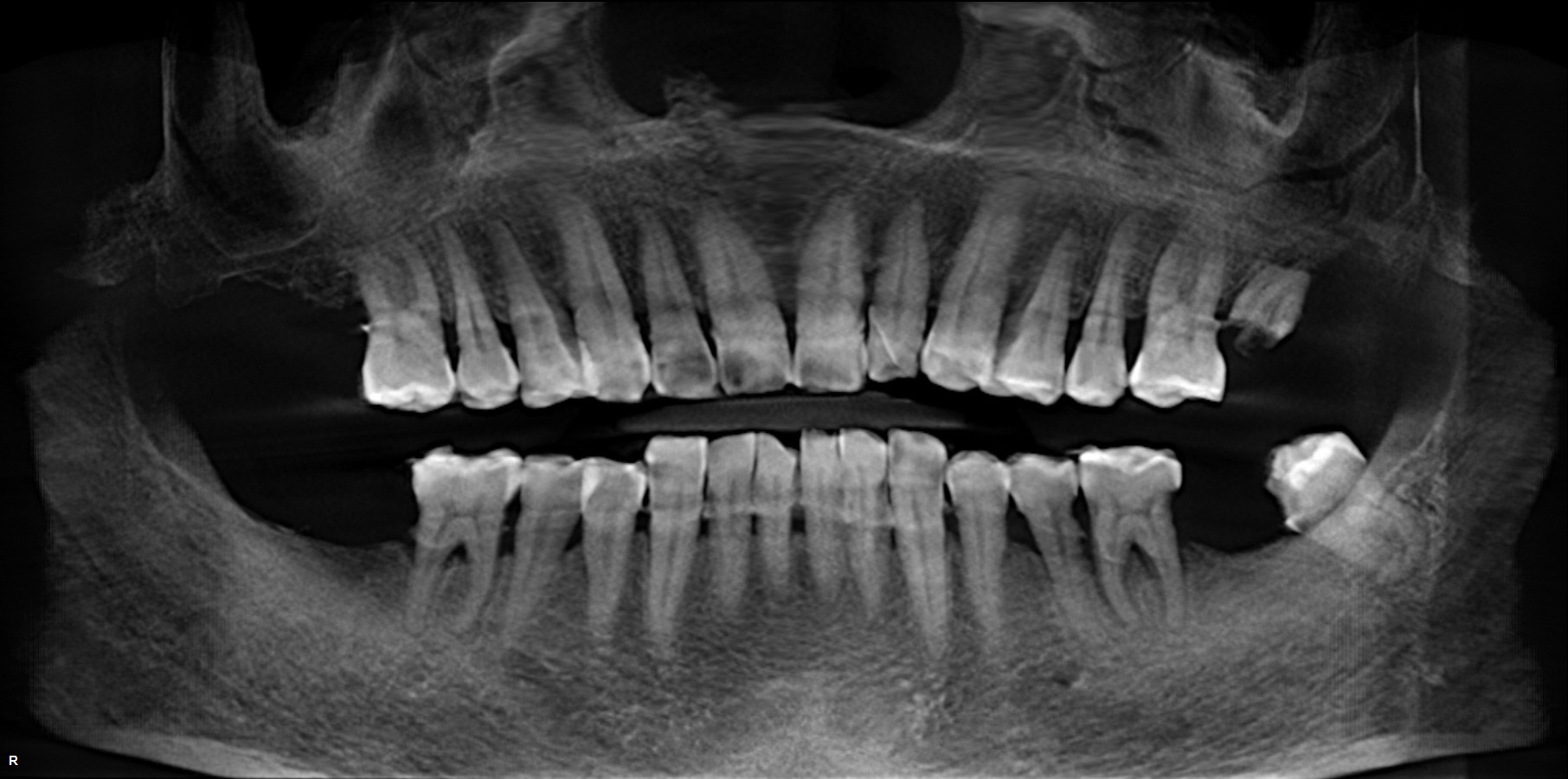 种植牙100问(22):7号牙缺失需要种植吗?