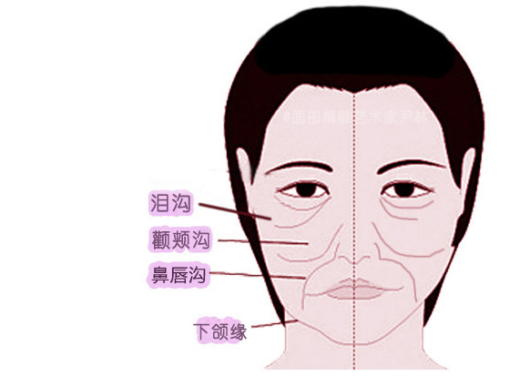 祛颊脂垫瘦脸与四条衰老线的关系泪沟颧颊沟鼻唇沟下颌缘