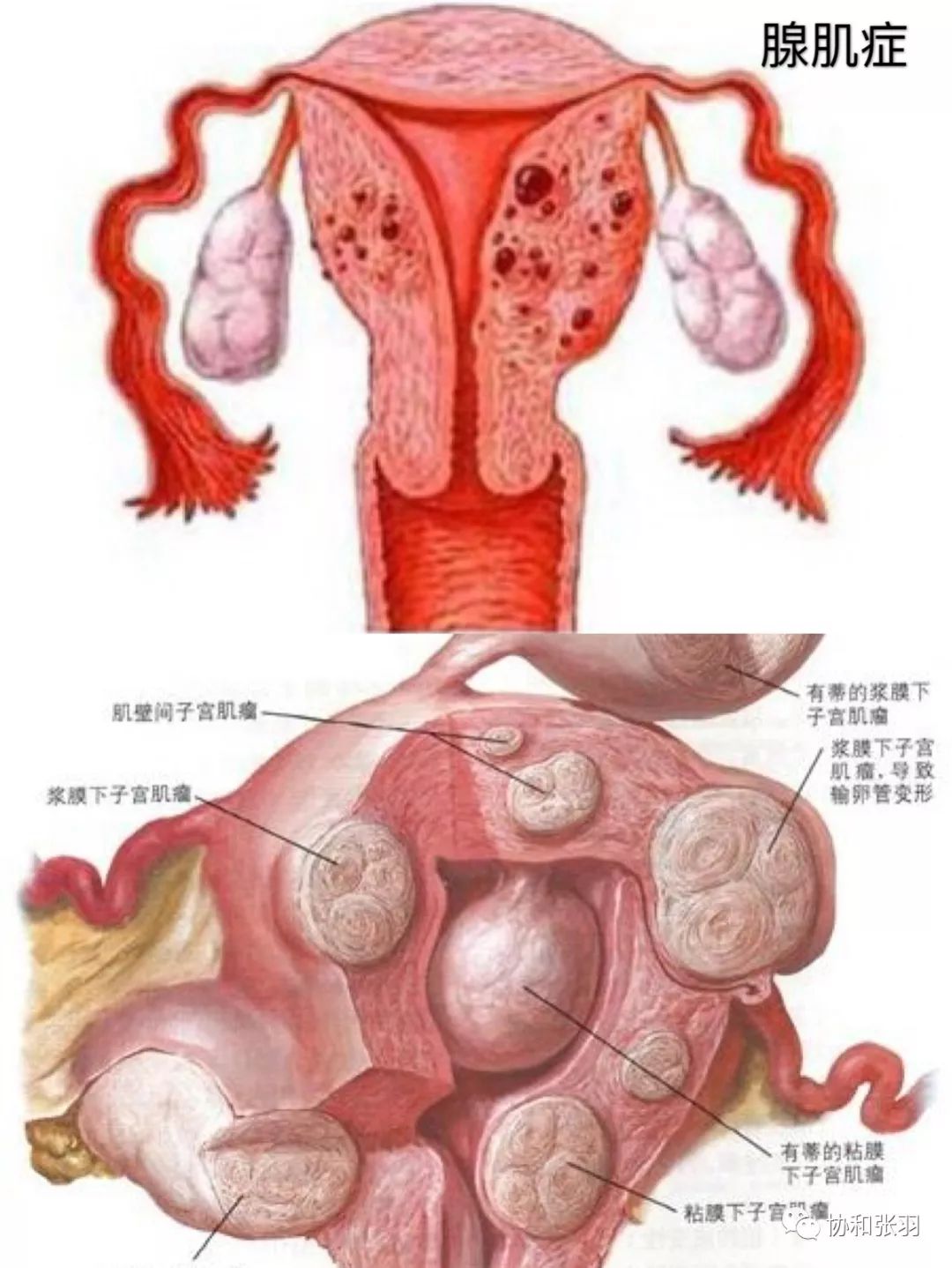 子宫腺肌症病灶图图片