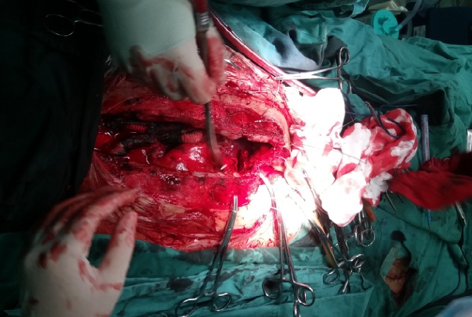 wang手术伟大实战成人重度胸廓畸形合并重度心脏病一期手术