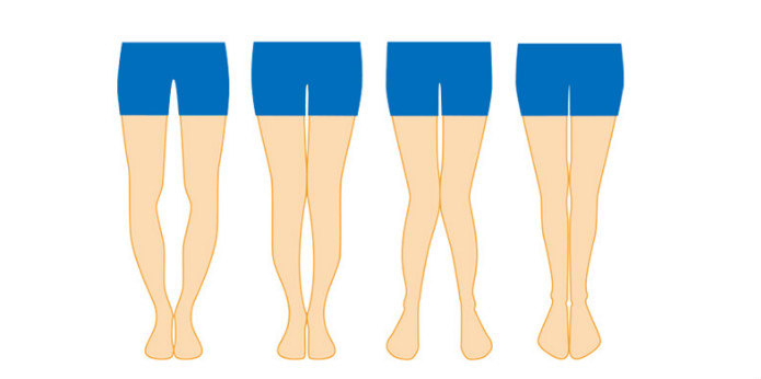 5岁孩子出现o型腿发育急坏宝妈造成o型腿的2大原因你知道