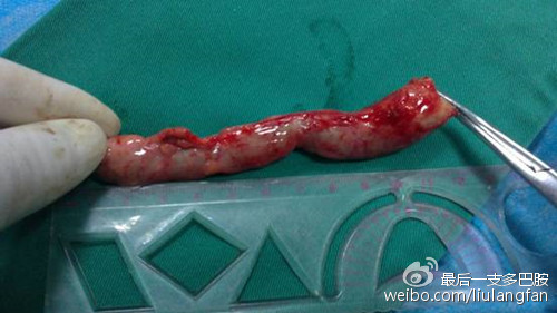 阑尾炎背后的故事你真的了解阑尾炎吗