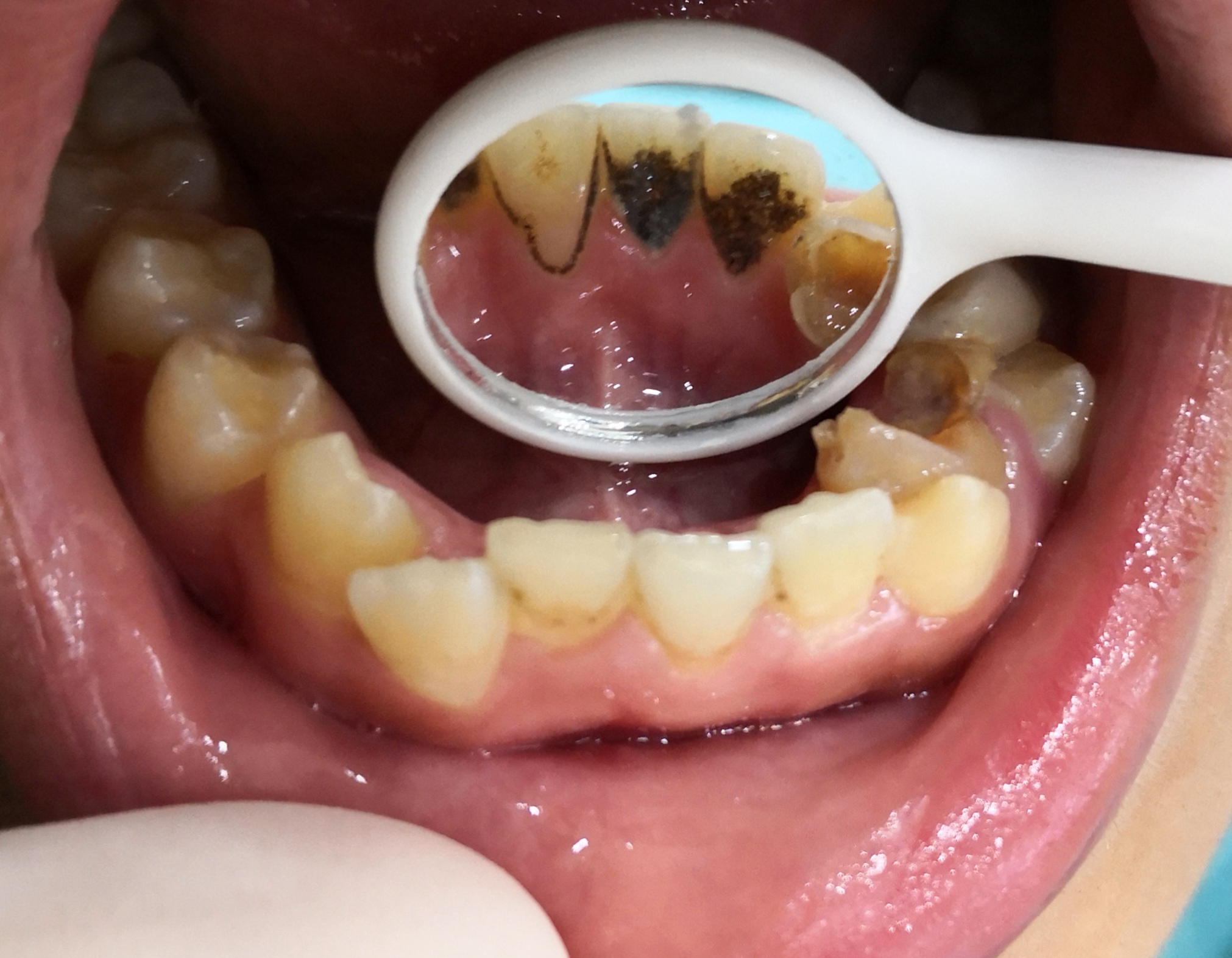 口呼吸的孩子有着痛苦的童年.