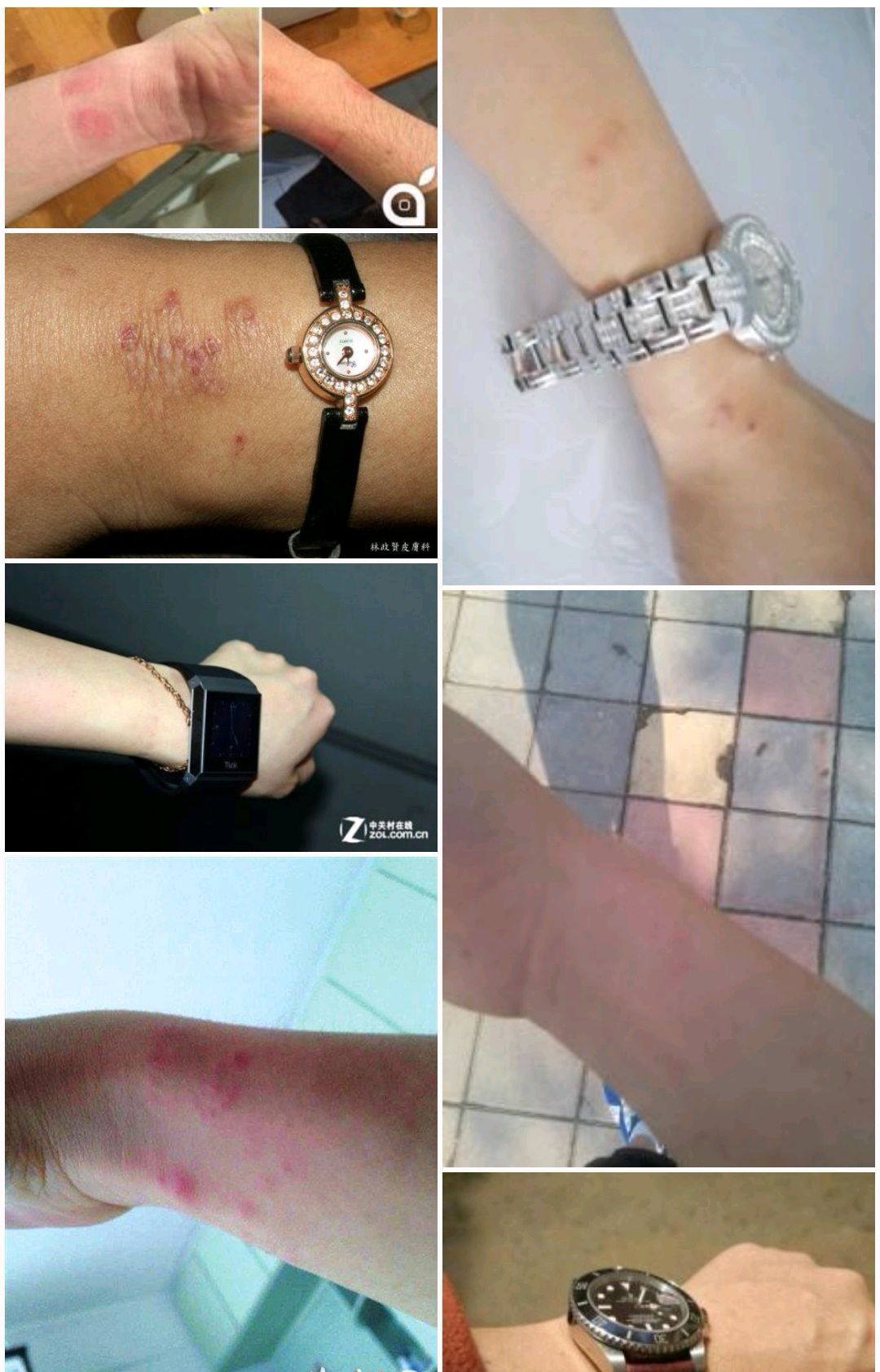 戴个项链也会过敏,甚至门把手也过敏,有人的人生似乎就是很艰难