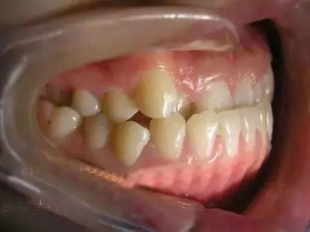 "地包天"牙齿,最好什么时候进行矫正?有哪些矫正方法?