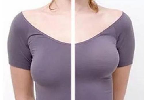 乳房不对称能否通过丰胸手术改善?