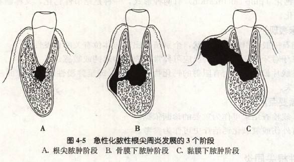 牙周袋发炎图片