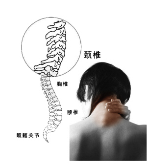 神经根型颈椎病的诊断要点